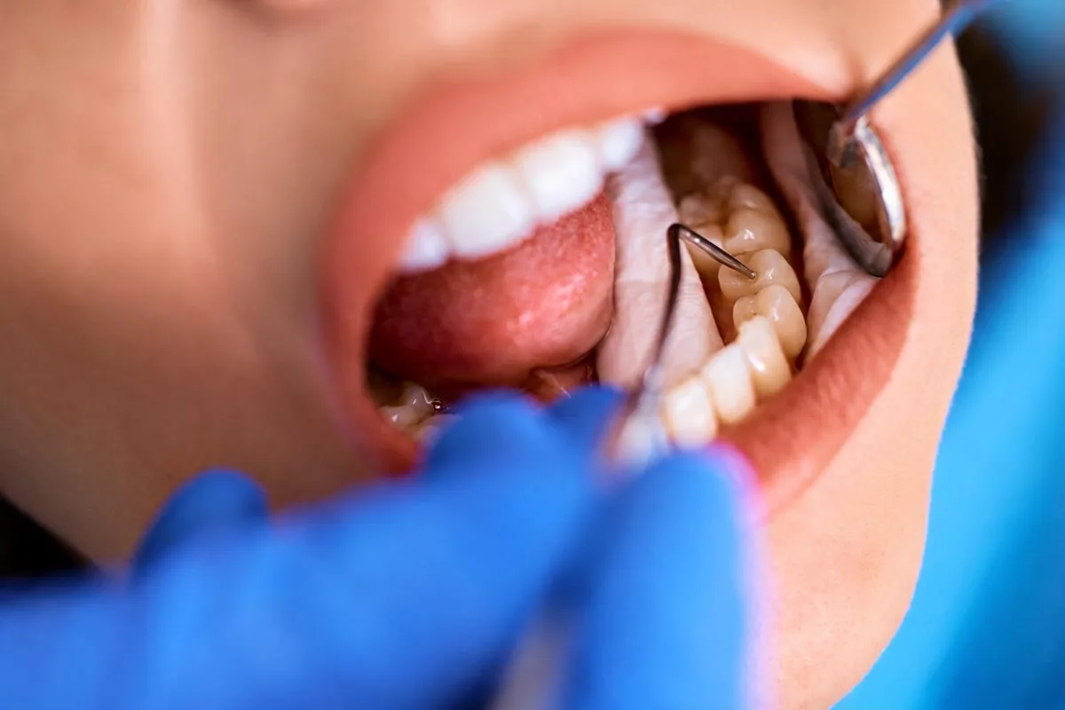 A clinician checking the upper teeth with a mirror