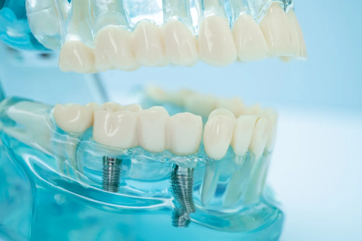 A model of a full arch of teeth supported on implants