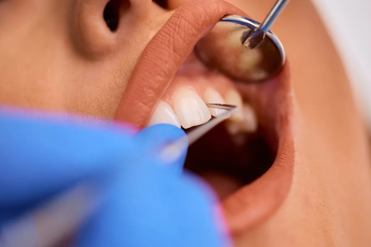 A close-up of gum treatment in progress