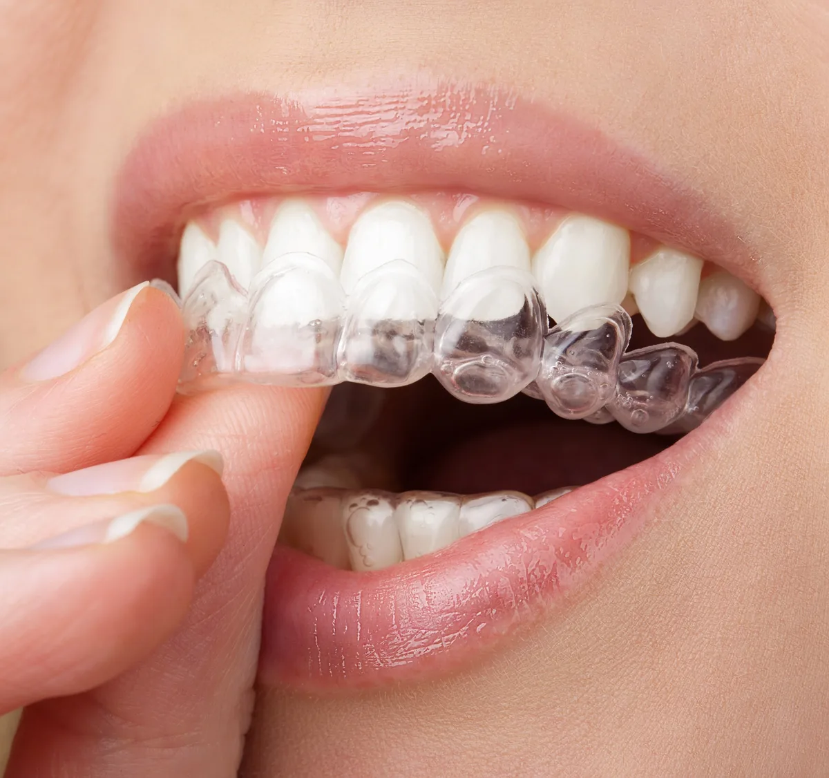 A patient placing a clear aligner over the upper teeth