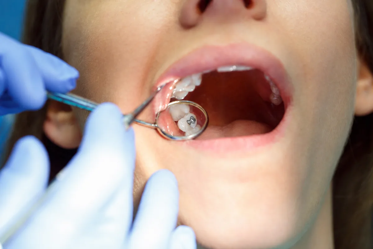 A clinician examining existing fillings with a mirror