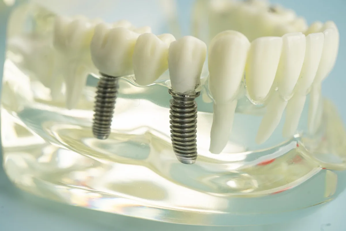 A model of a lower arch restored on implants