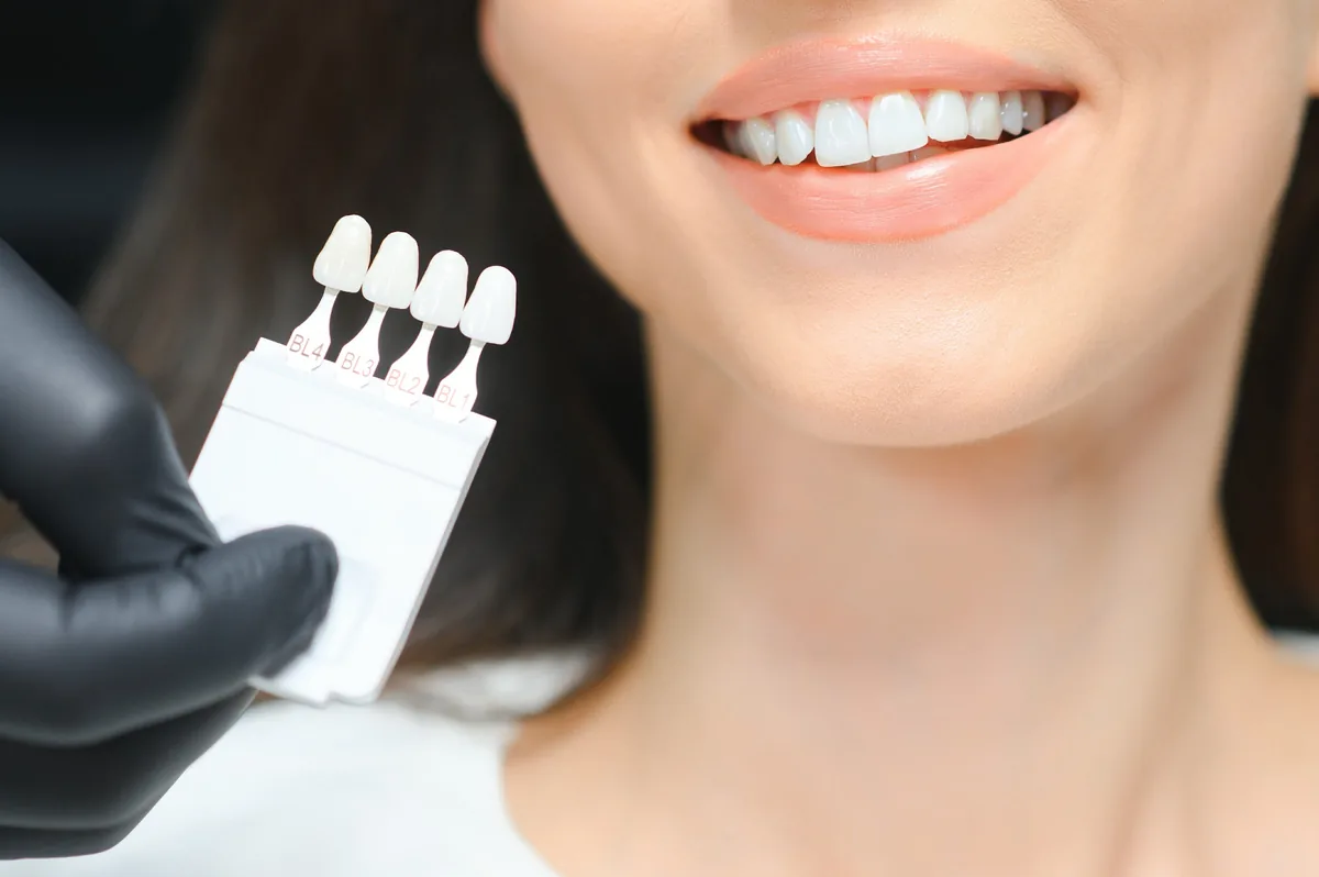 A shade guide held beside a patient's smile