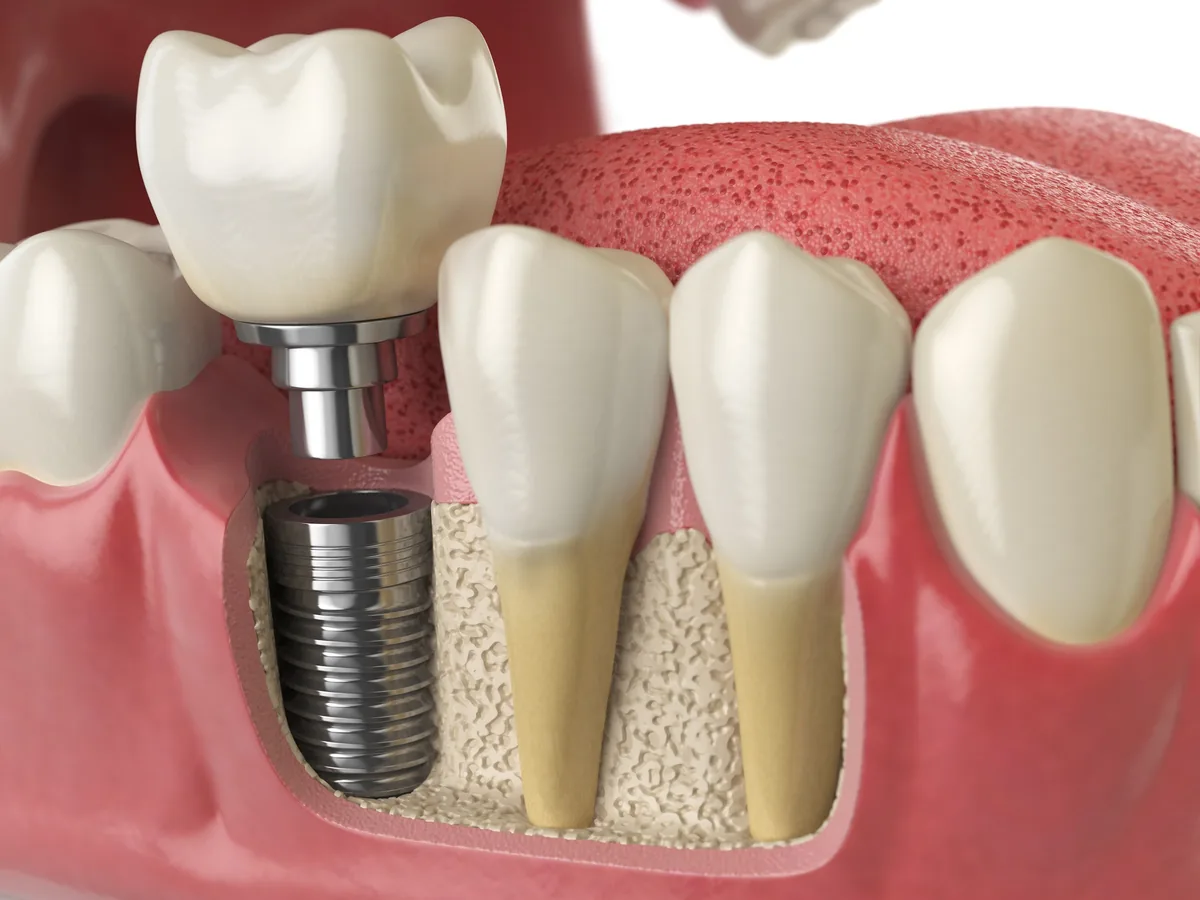 An illustration of a single implant and crown replacing one missing tooth