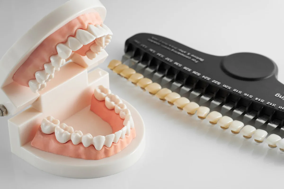 A model of the teeth beside a row of crown shade samples